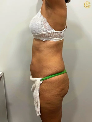 Foto antes e depois